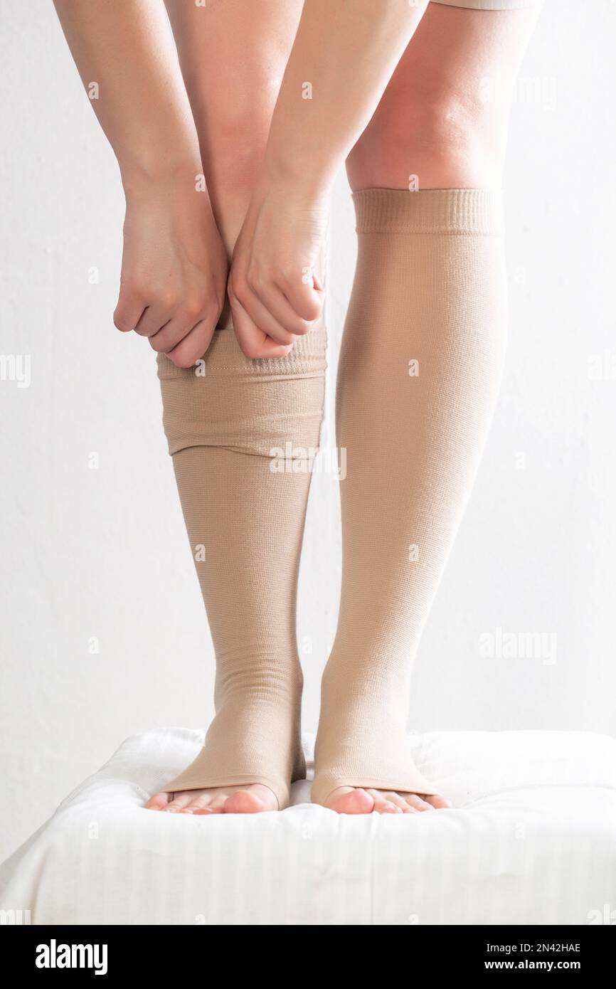 The varicose veins on a legs of woman Stock Photo - Alamy
