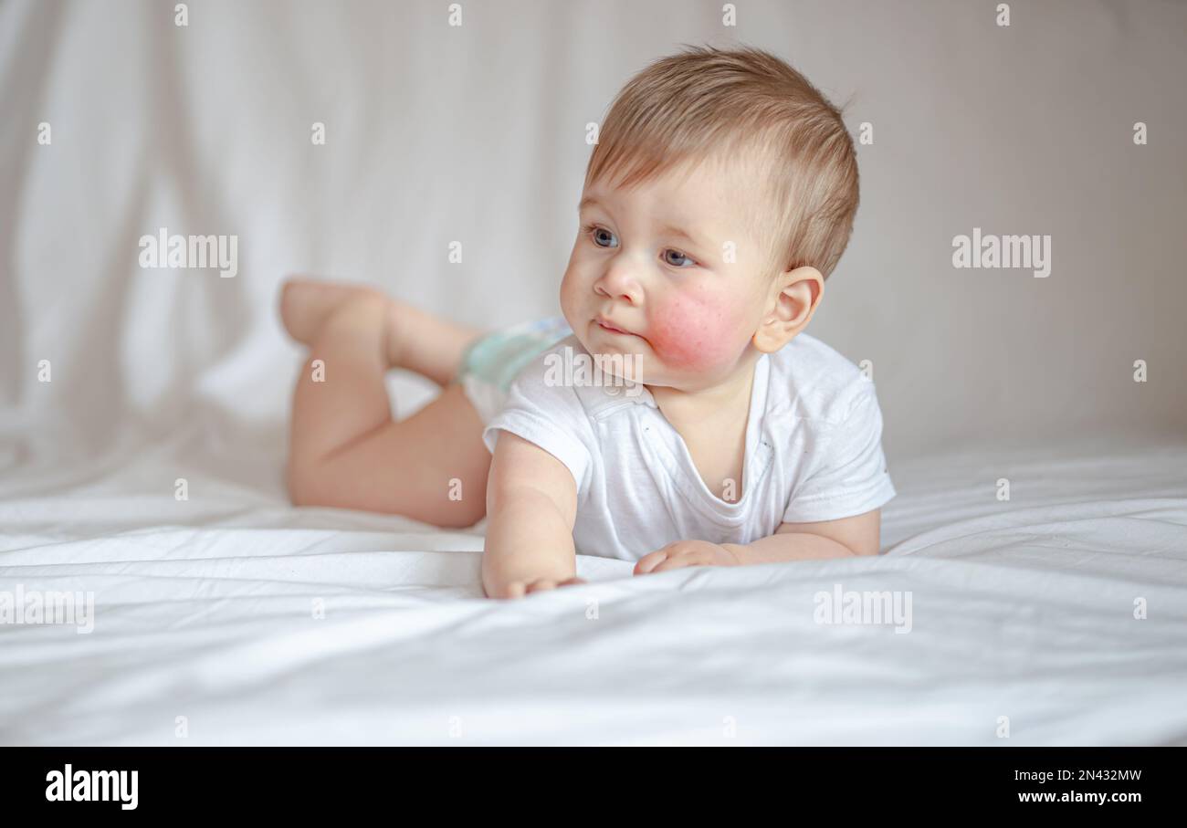 Atopic dermatitis eczema in baby.Condition that causes the skin to red,dry,sore,itchy and