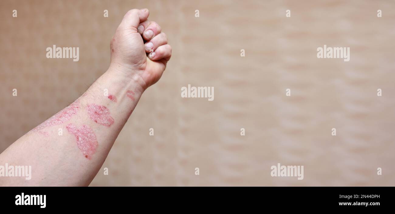 Man with sick arm, dry flaky skin on his hand with vulgar psoriasis