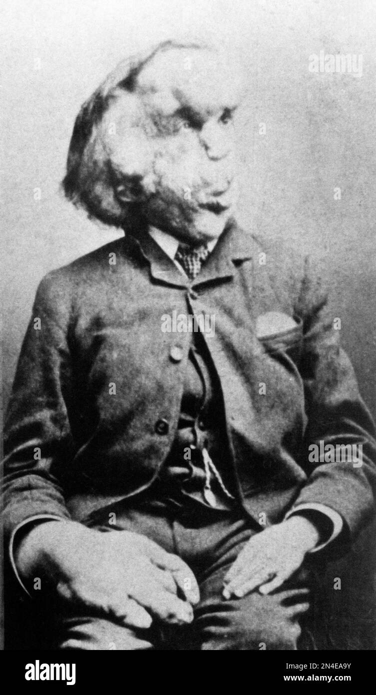 Joseph Merrick, the Elephant Man. Portrait of Joseph Carey Merrick (1862-1890) who had severe physical deformities, c. 1889 Stock Photo