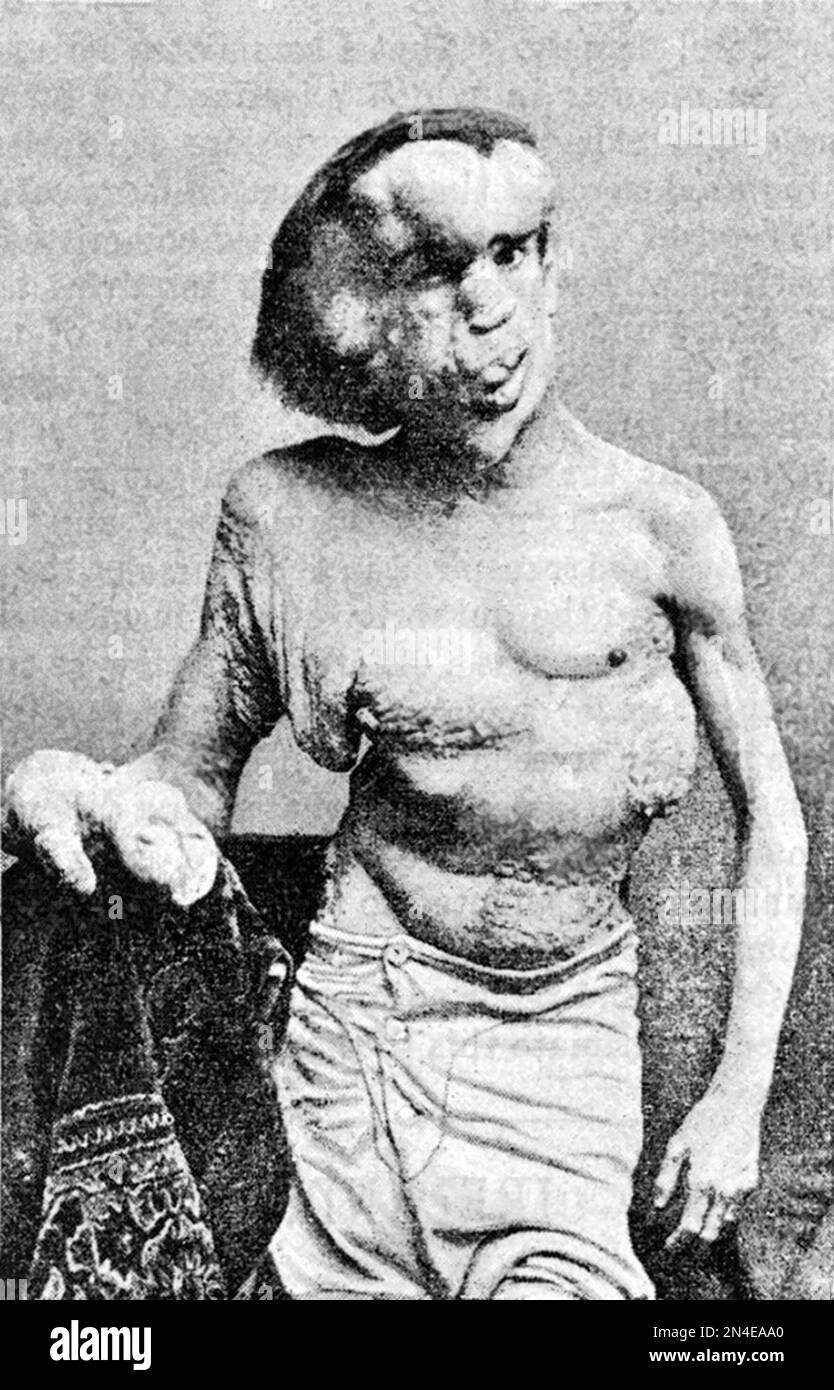 Joseph Merrick, the Elephant Man. Portrait of Joseph Carey Merrick (1862-1890) who had severe physical deformities, 1889 Stock Photo