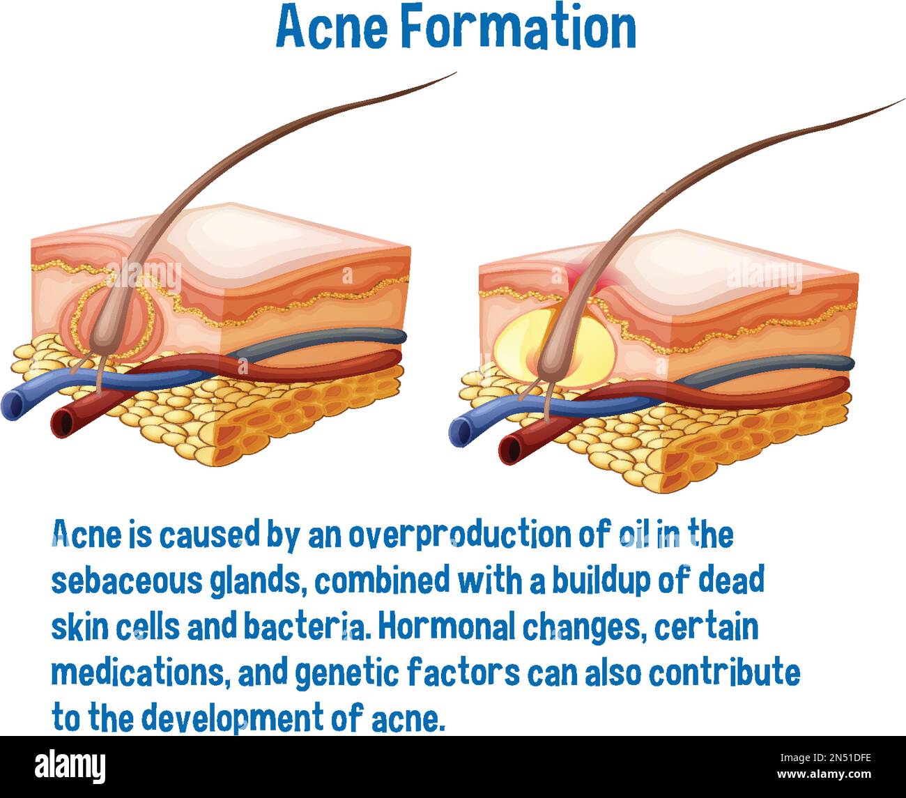 Acne formation information explanation illustration Stock Vector