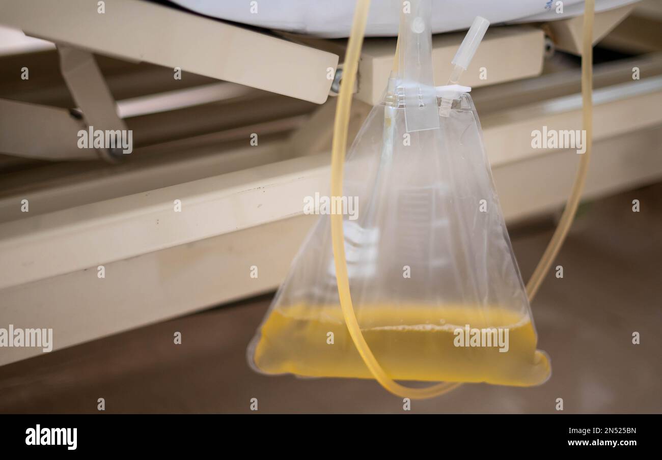 The urine or pee catheter bag hangs under a patient's bed in a hospital