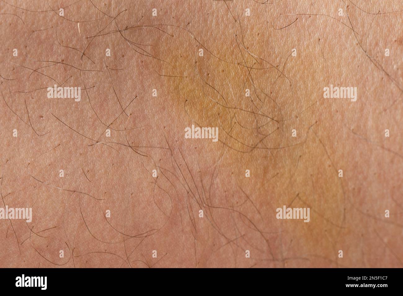 Beaten spot on human skin macro close up view Stock Photo