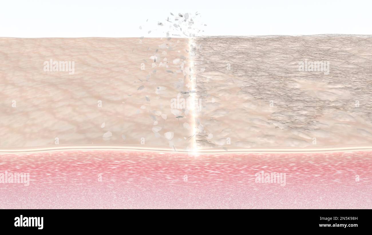 Skin peel. Human skin fibers cross-section before and after chemical peeling, laser resurfacing, microdermabrasion, or other beauty treatment procedure Stock Photo