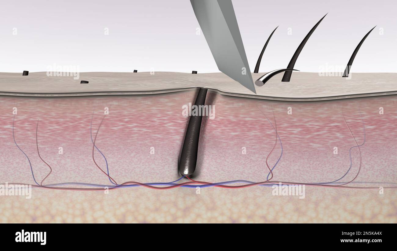 Hair shaving with bad results. A razor blade cuts body hair. 3D 