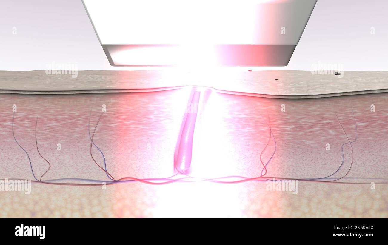 Laser epilation. Hair removal procedure. 3d rendered illustration. Skin