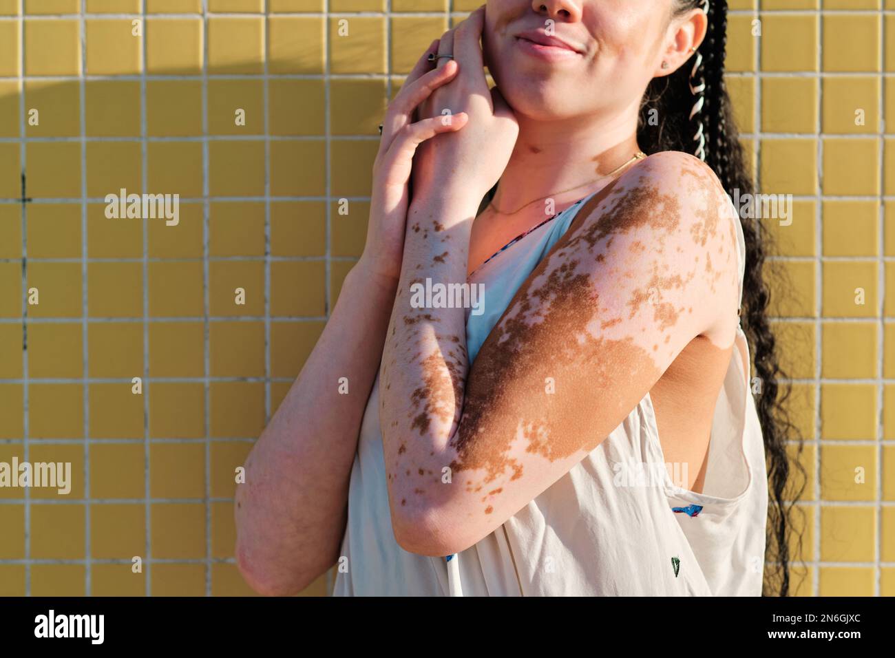 Close-up view of a woman with vitiligo posing outdoors. Stock Photo