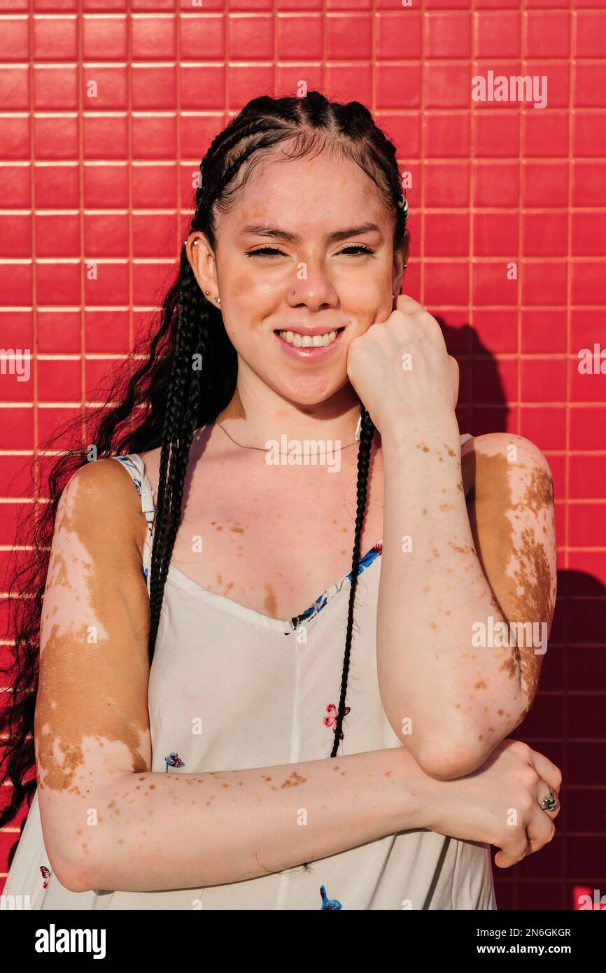 Young woman with vitiligo looking at camera and smiling while posing against wall outdoors. Stock Photo
