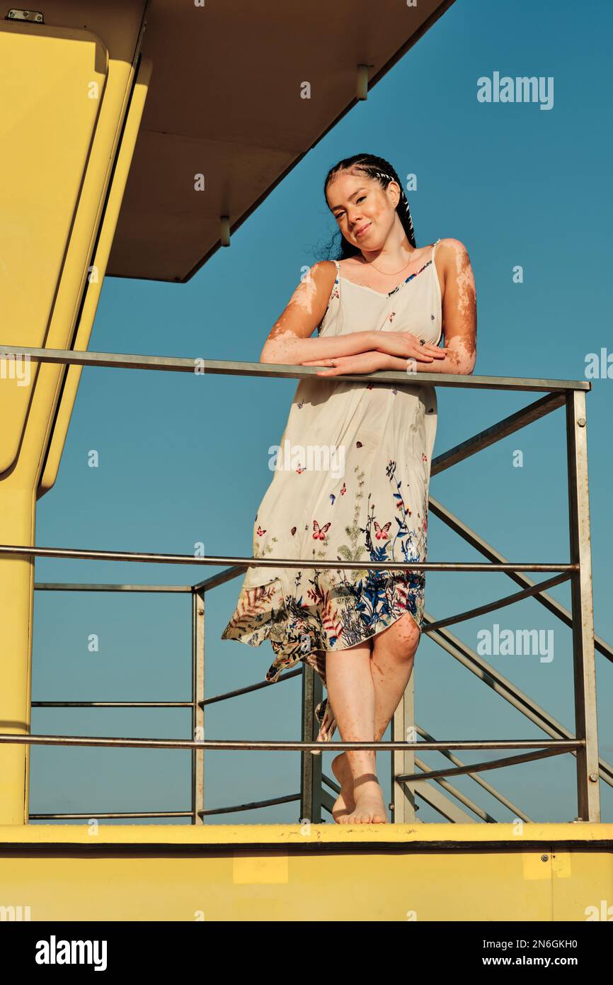 Woman with vitiligo posing outdoors on a sunny summer day. Stock Photo