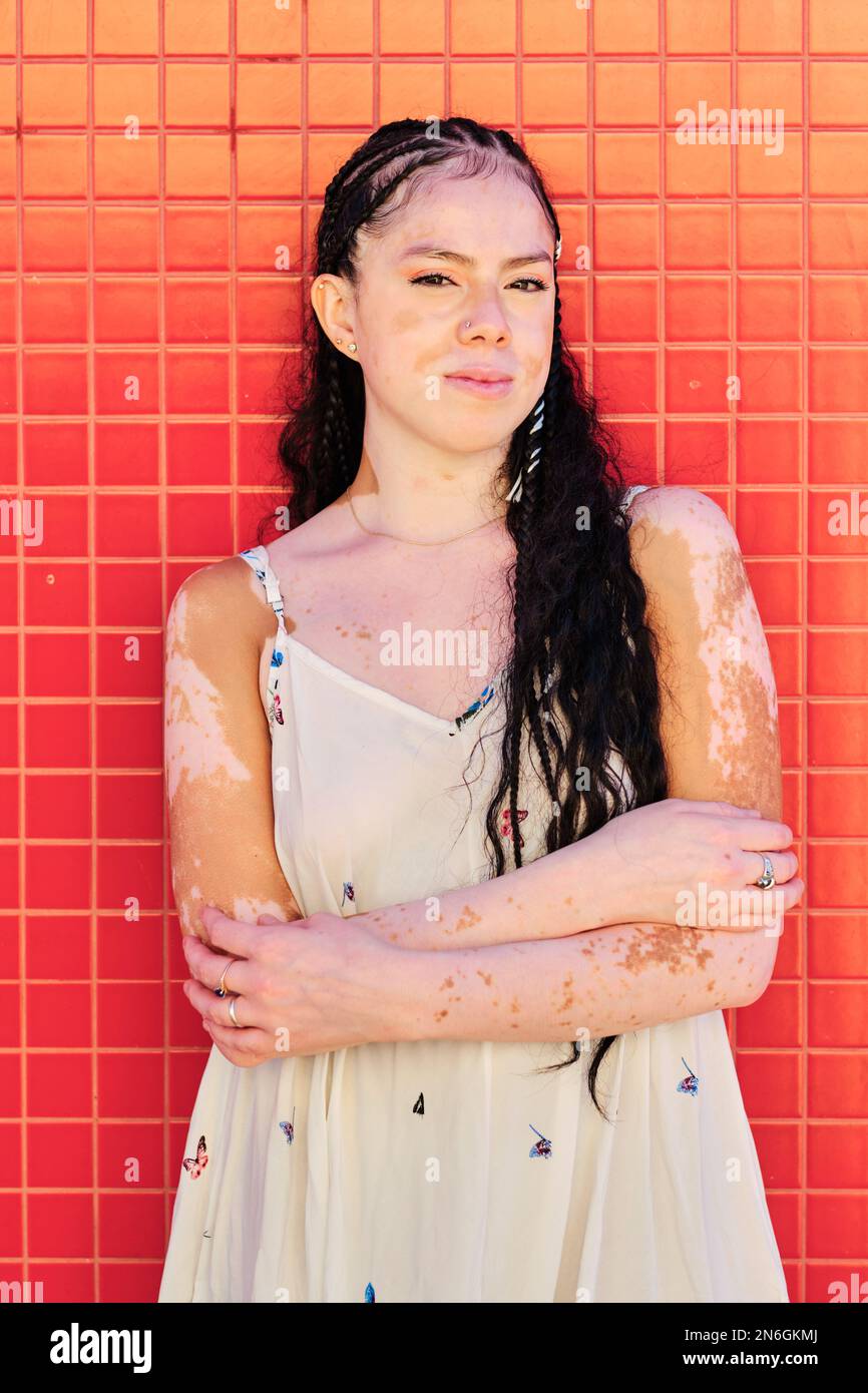 Woman with vitiligo looking at the camera while posing against a colour wall outdoors. Stock Photo
