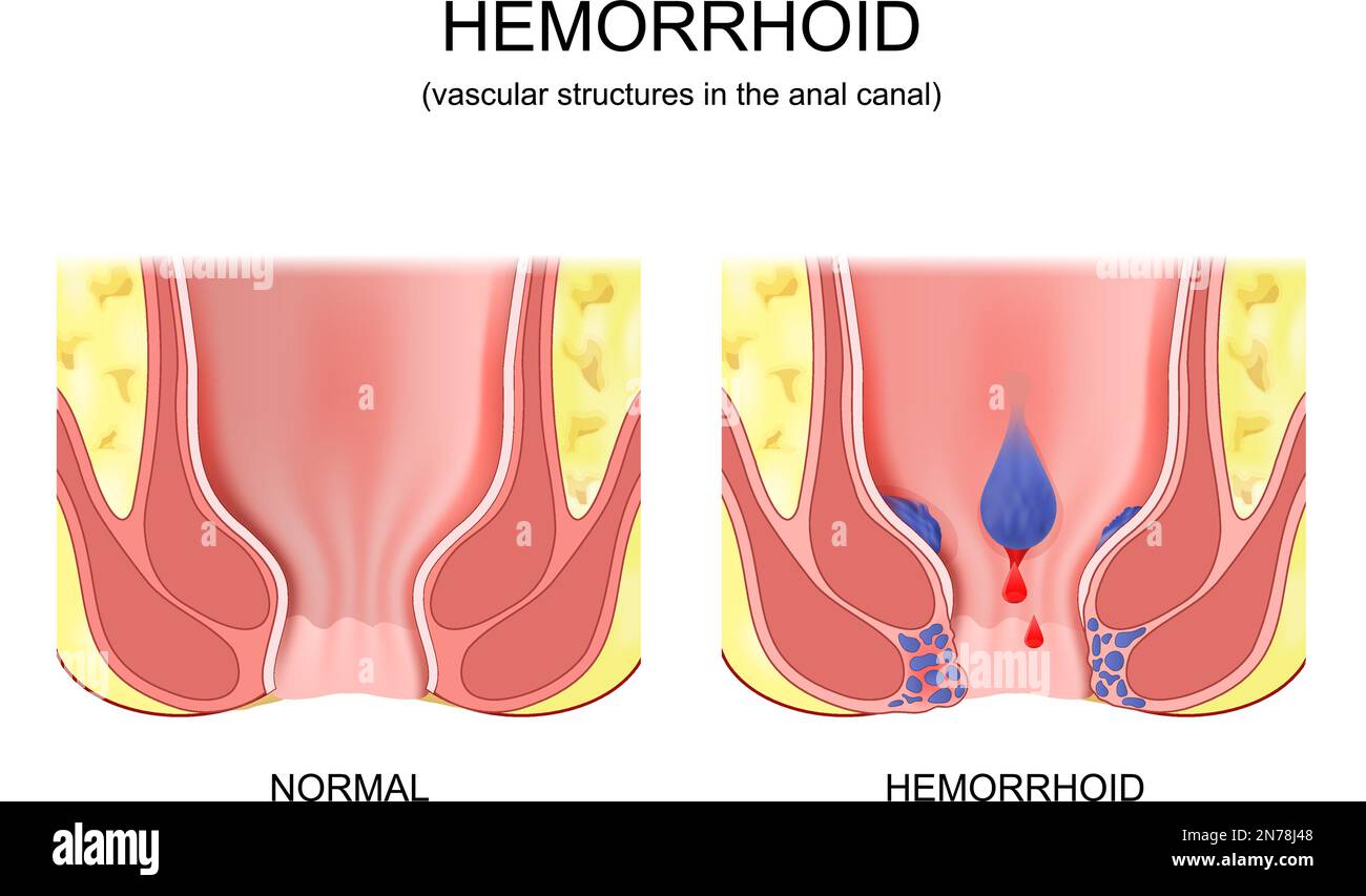Inside Piles piles. hemorrhoidal disease. comparison and differences between healthy ...