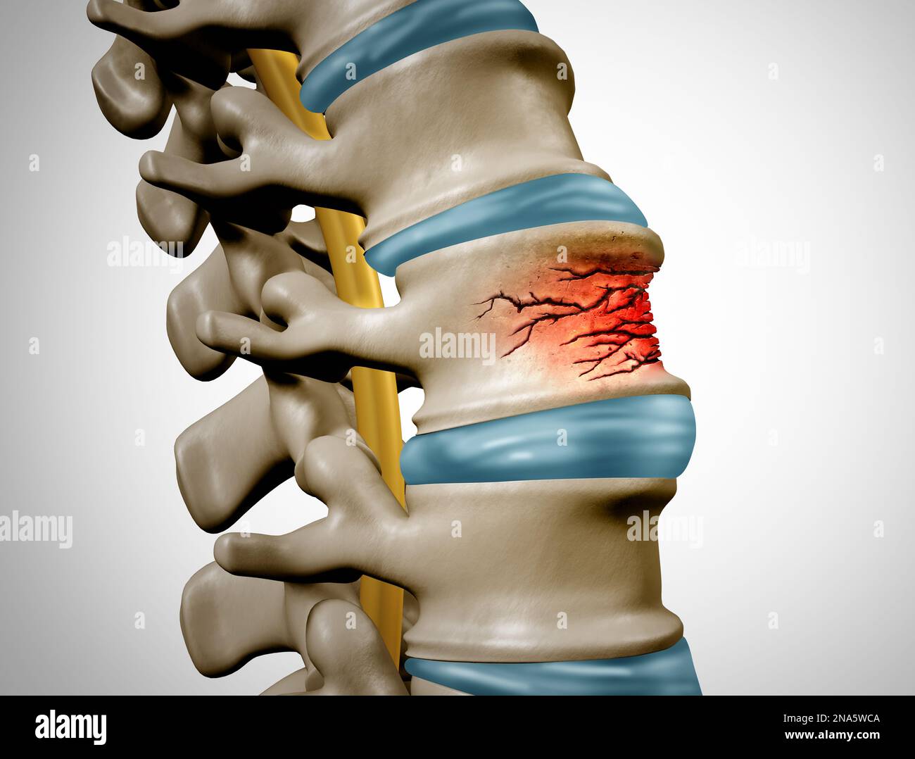 Traumatic Spine Fracture and vertebral injury medical concept as a human anatomy spinal column with a broken burst vertebra due to compression Stock Photo