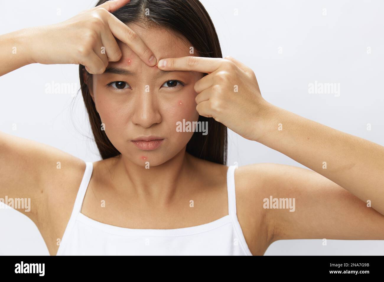 Asian woman facial skin problems, acne and inflammation, red rashes and allergies, chicken pox