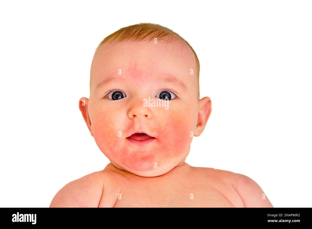 Portrait of a happy infant baby with allergies, red skin dermatitis
