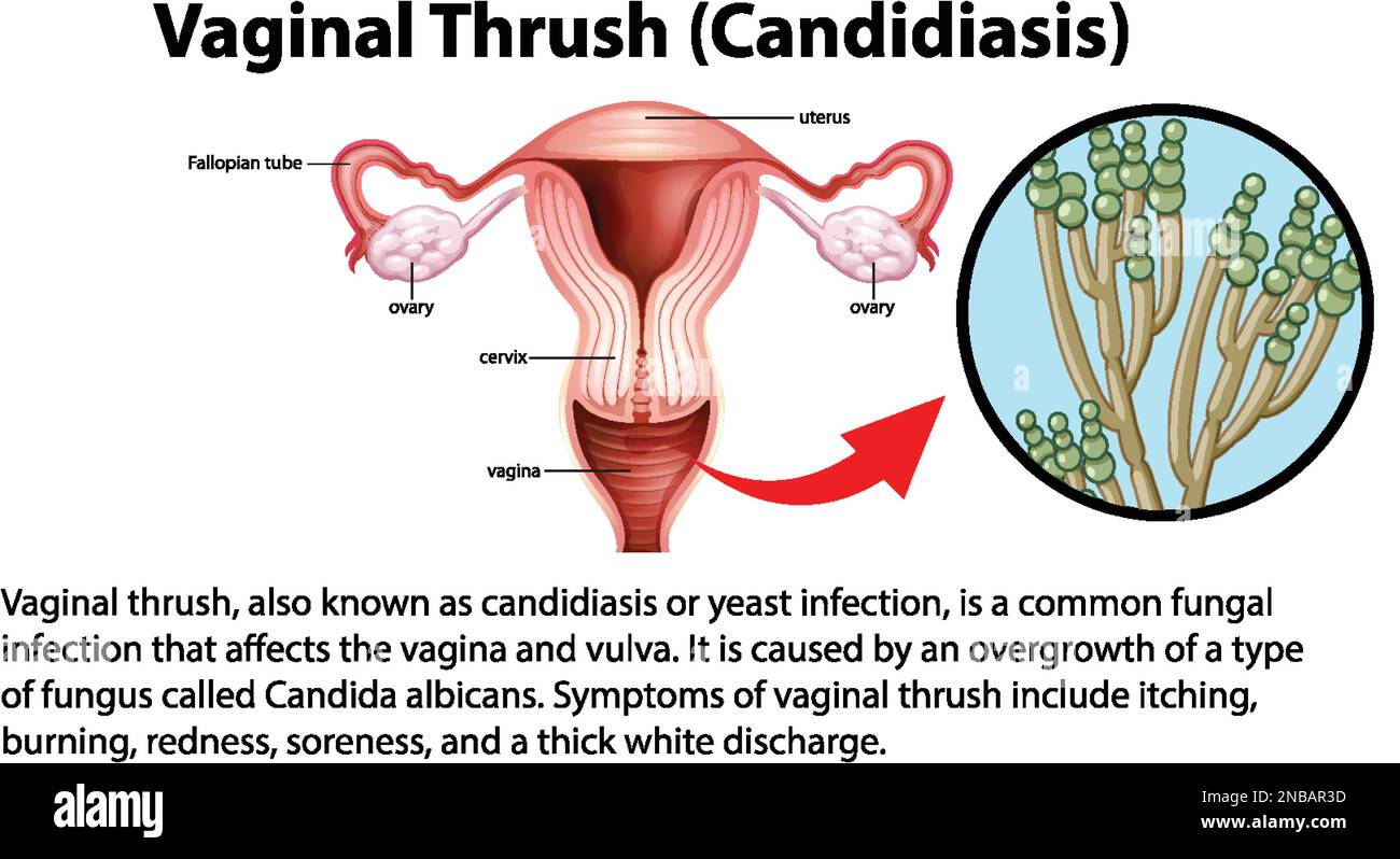 Vulvar thrush 2024