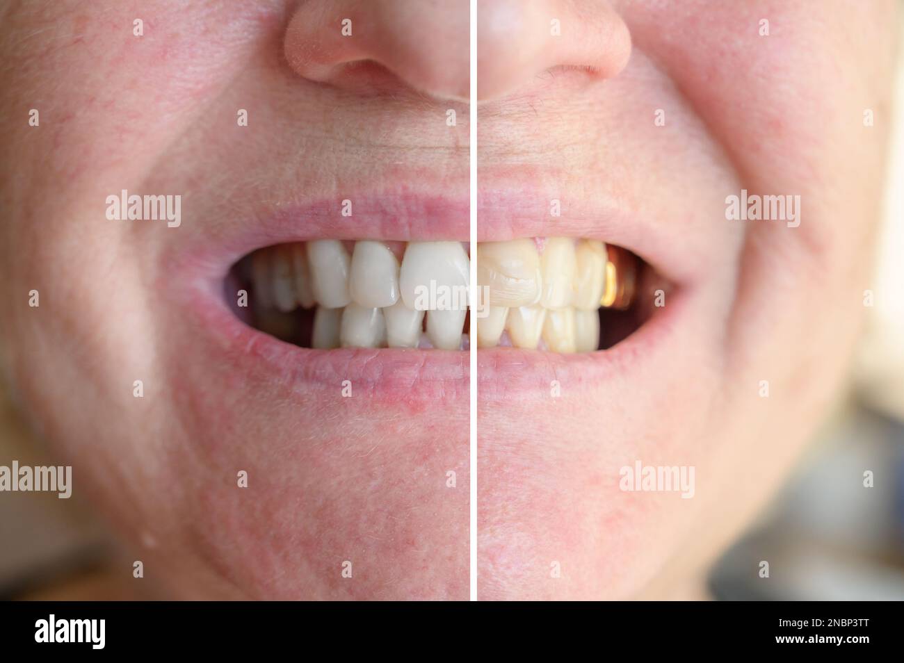 Before and after teeth whitening procedure Stock Photo Alamy