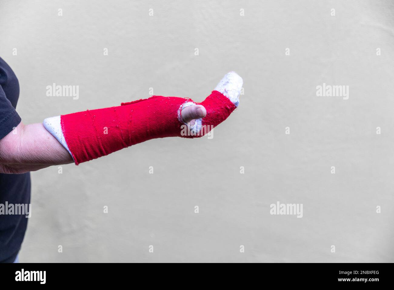 broken arm bone in cast (Red Stock Photo Alamy