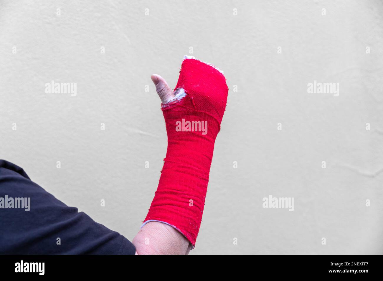 broken arm bone in cast (Red Stock Photo Alamy