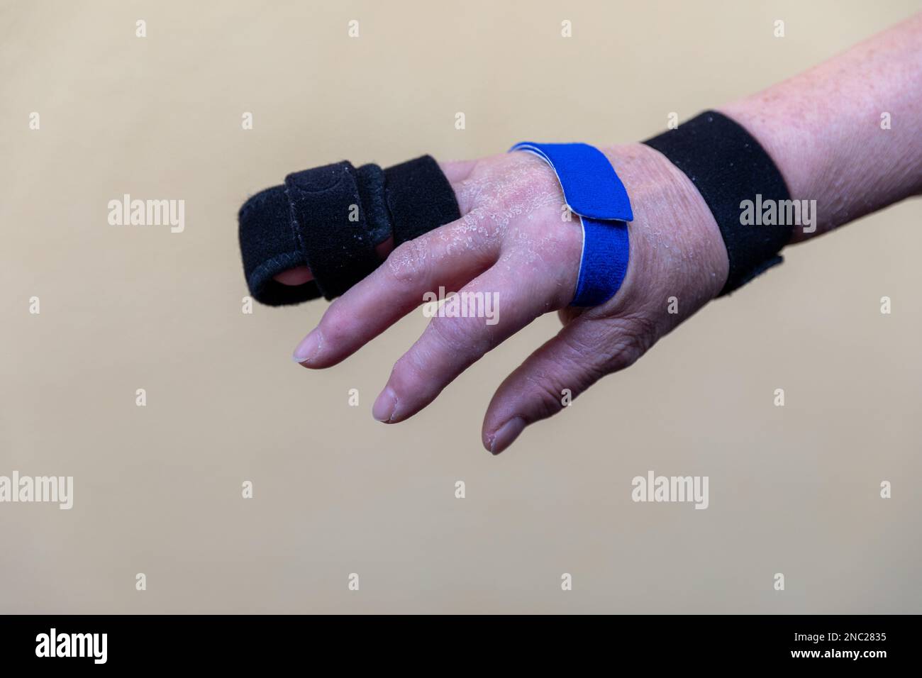 Finger Strap Joint Sprain Fixator Postoperative Fixation Splint