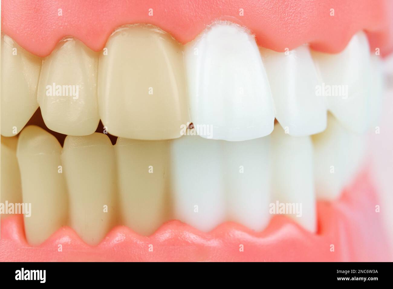 Clean and dirty tooth before and after whitening. Dental Teeth Model