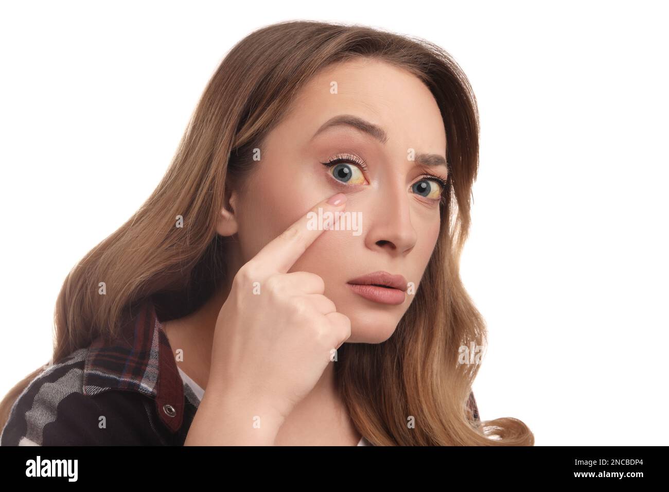 Woman with yellow eyes on white background. Liver problems symptom