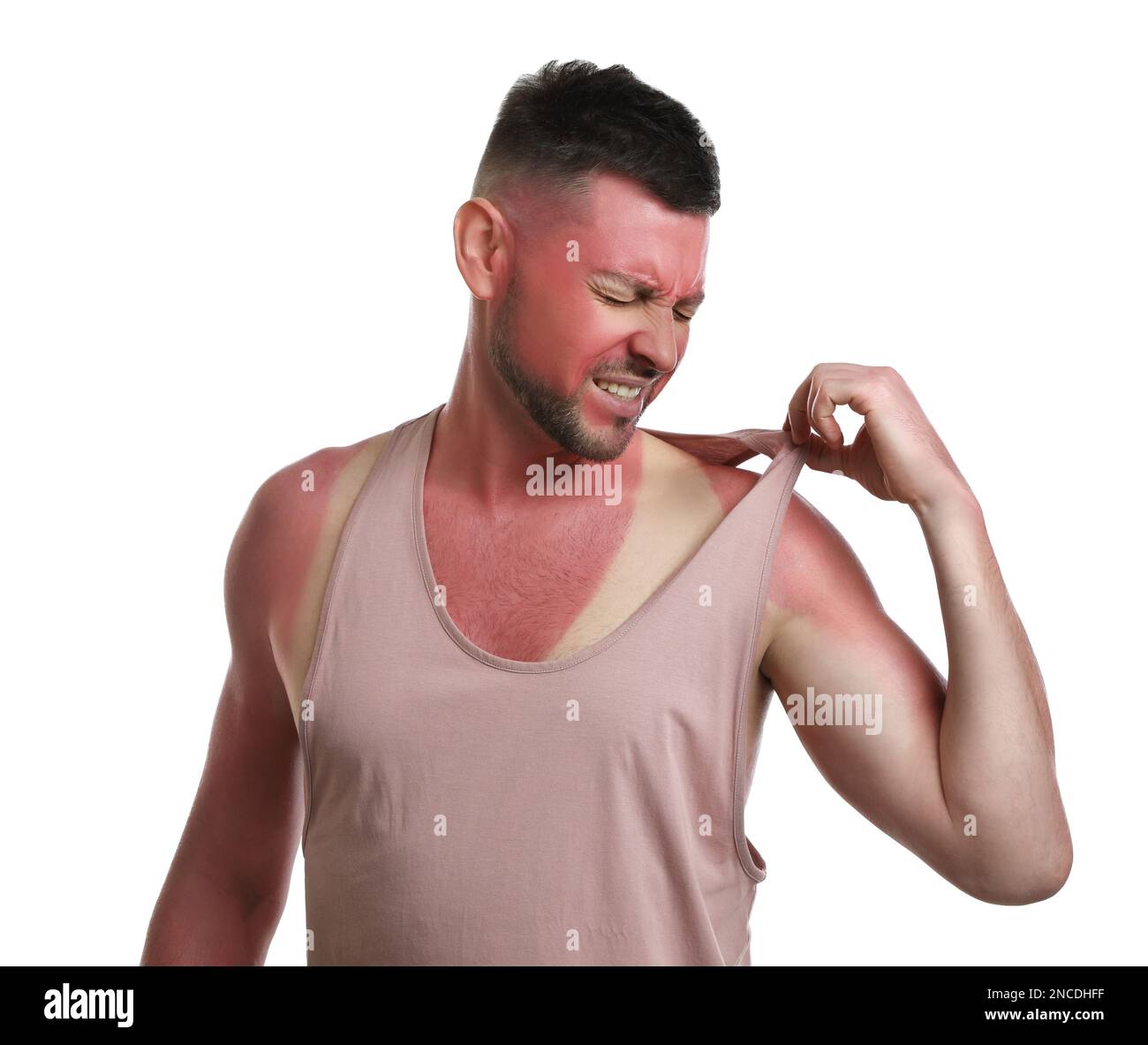Man with sunburned skin on white background Stock Photo - Alamy