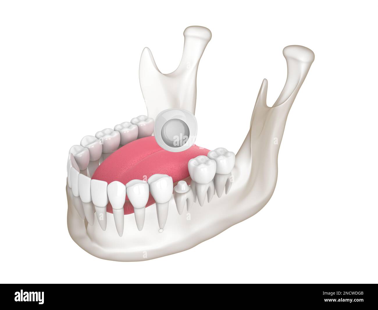 3d render of mandible with dental crown embed on reshaped tooth over
