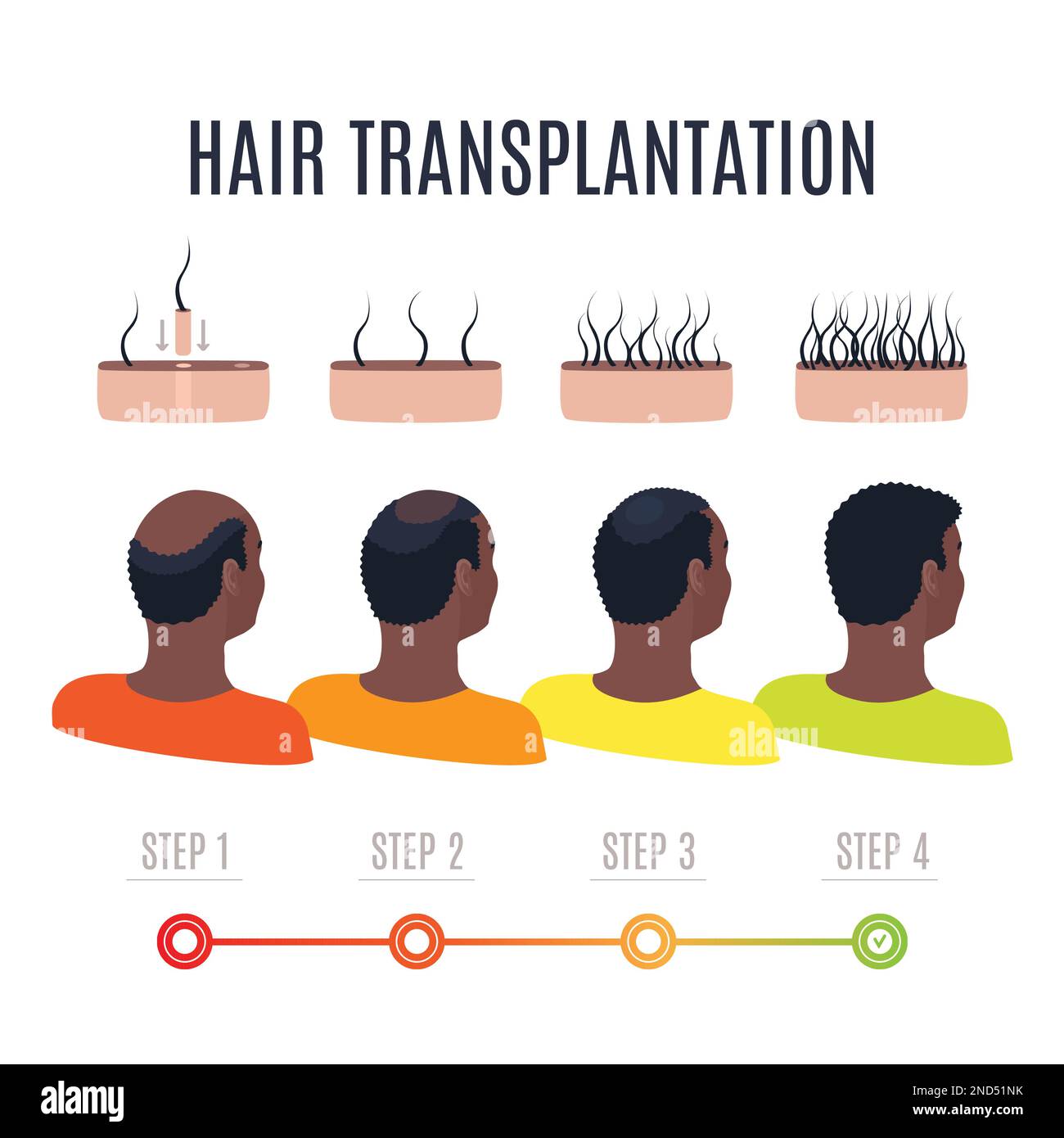 Afro-textured hair transplantation surgery result infographics Stock Vector