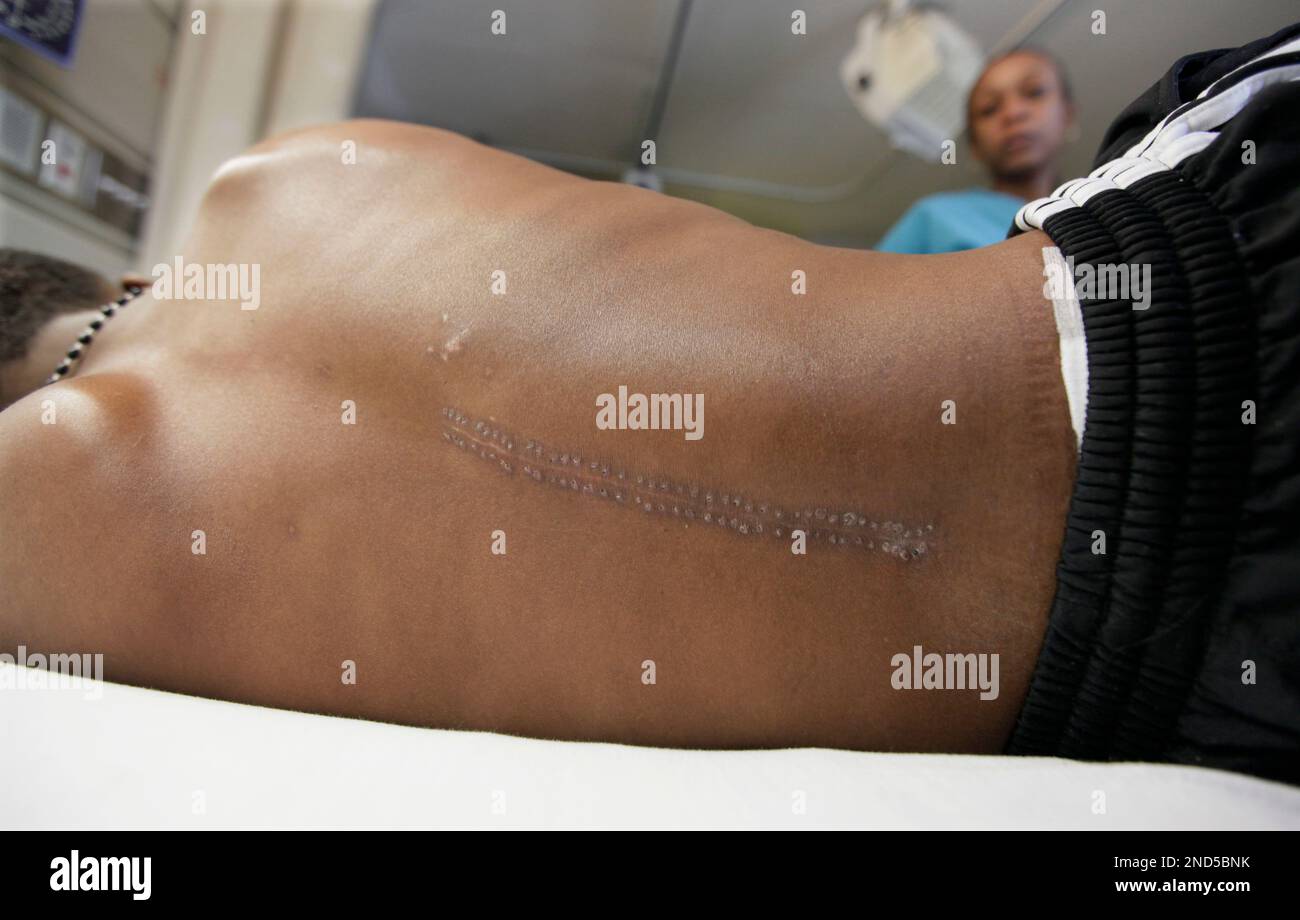 In this photo taken Feb. 24, 2010, a surgical scar is seen on his back ...