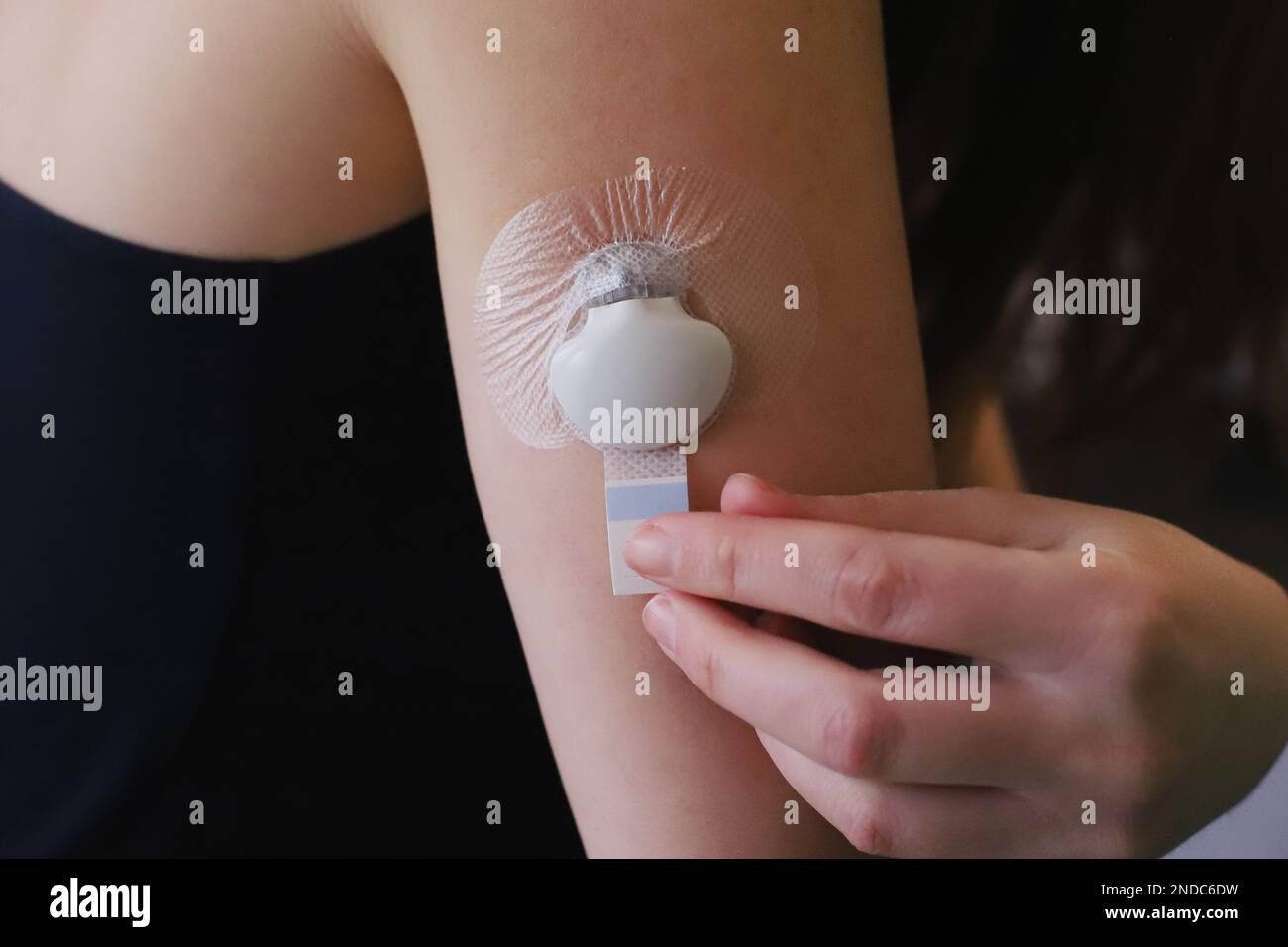 Inserted blood glucose sensor with transmitter and adhesive sticker ...