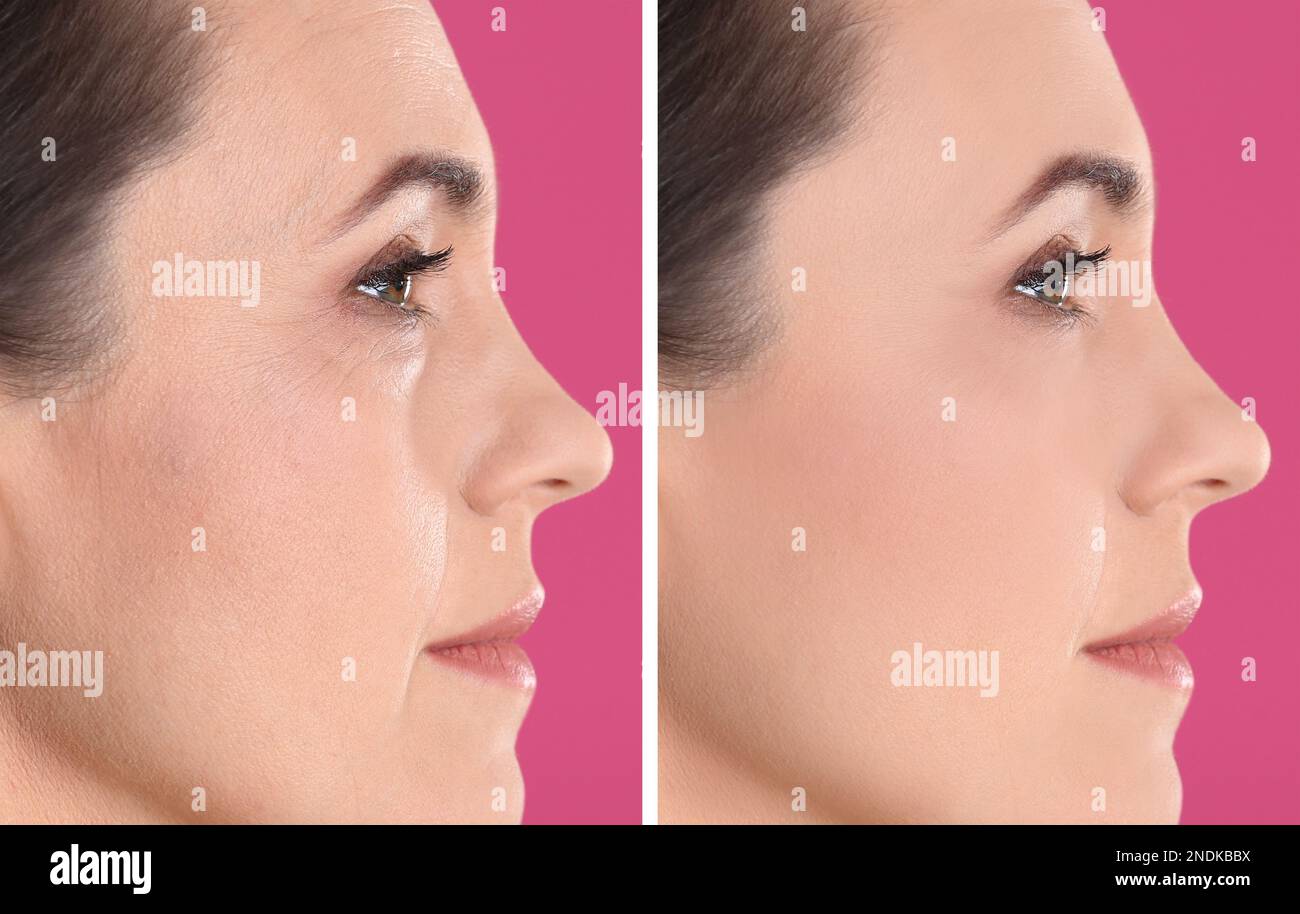 Collage with photos of mature woman before and after biorevitalization