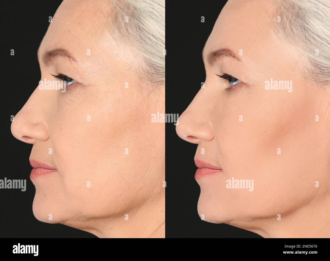 Collage with photos of mature woman before and after biorevitalization