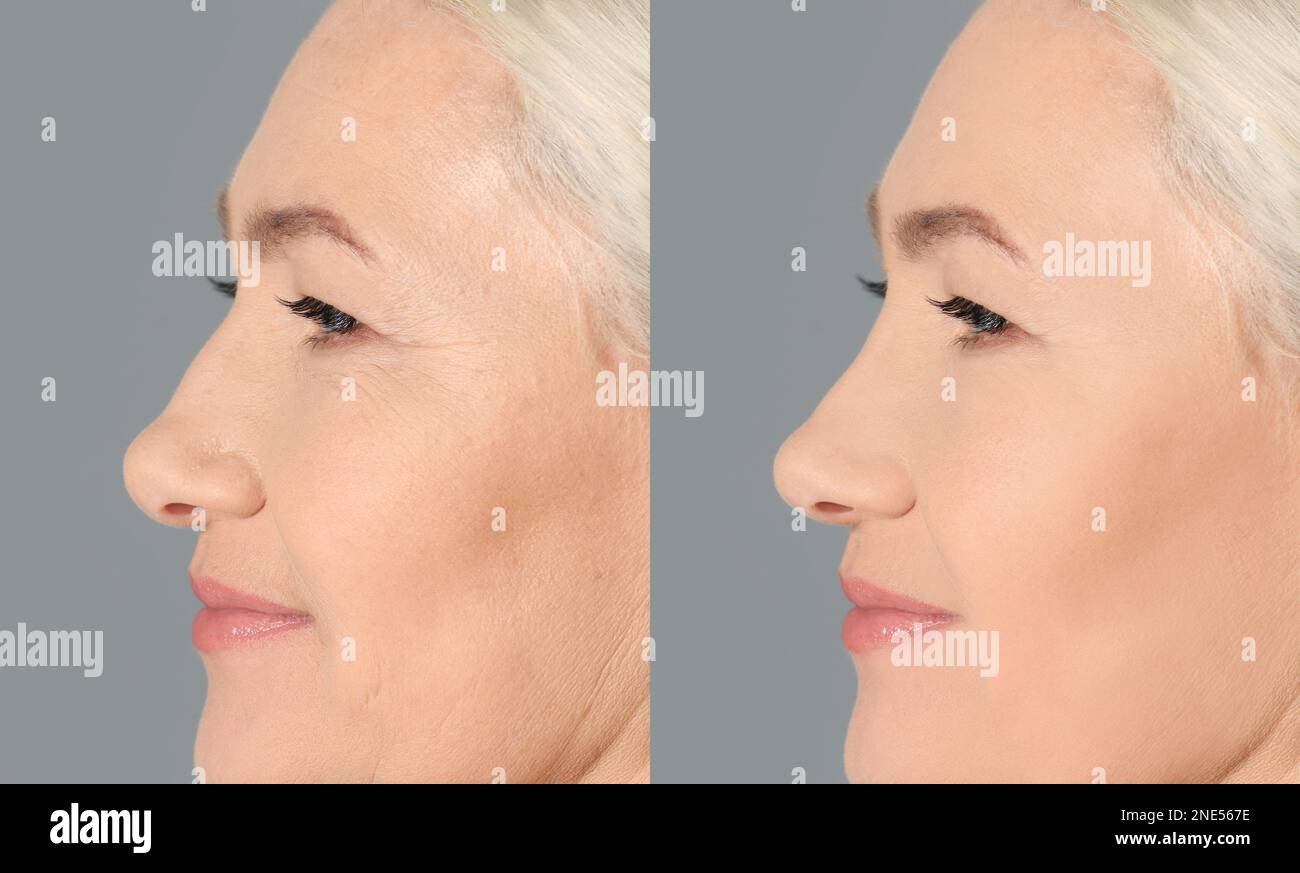 Collage with photos of mature woman before and after biorevitalization