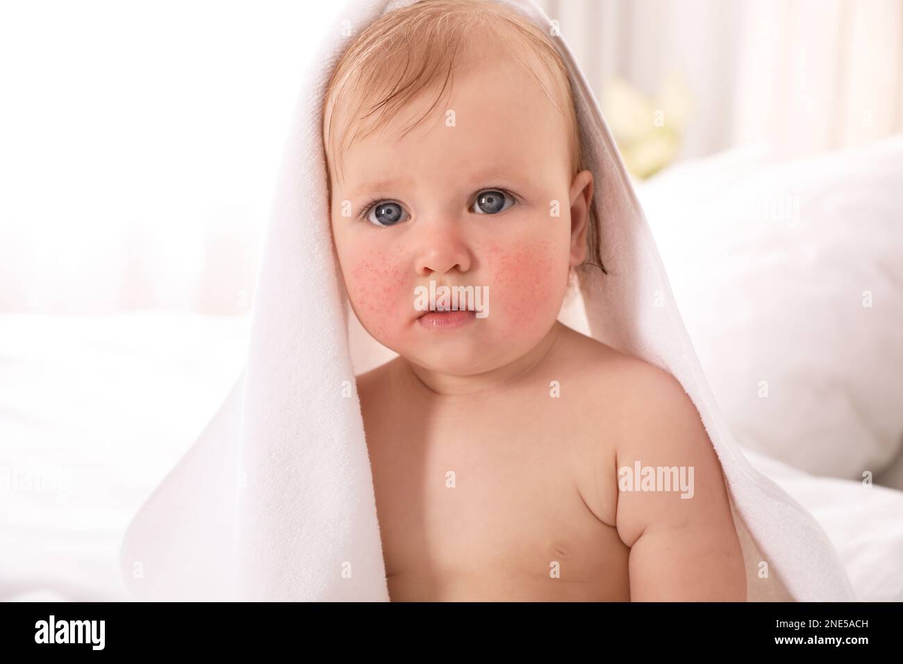 Cute little baby with allergy symptoms on cheeks at home Stock Photo