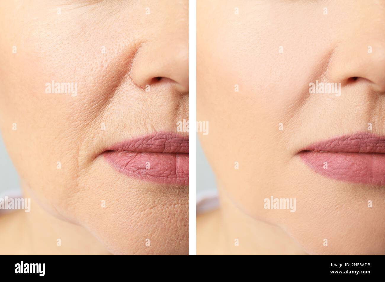 Collage with photos of mature woman before and after biorevitalization