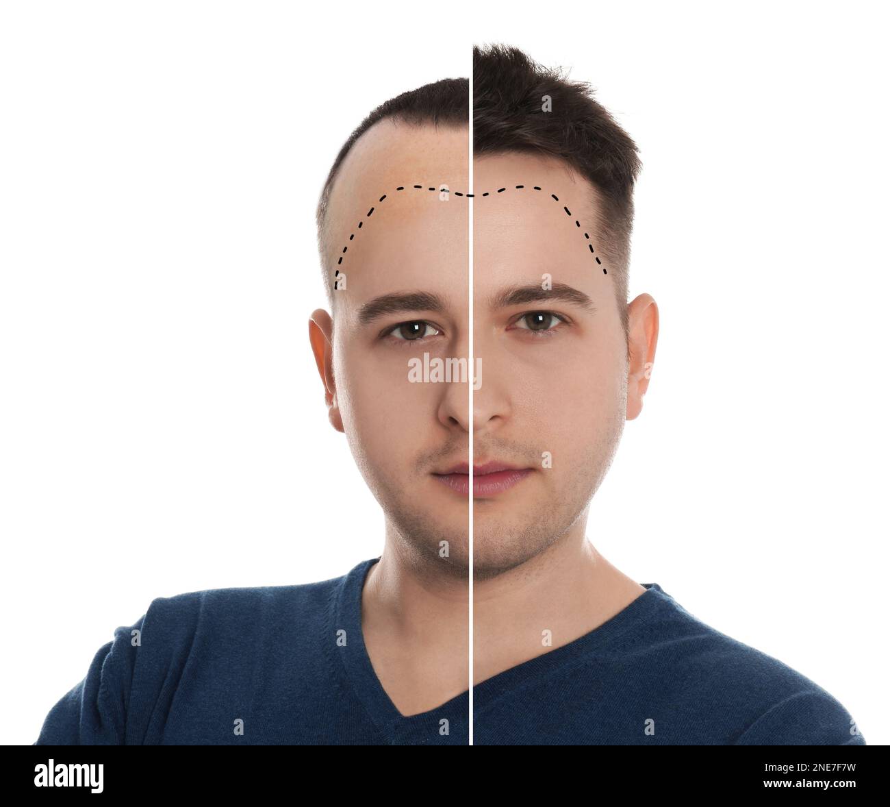 Man before and after hair loss treatment on white background, collage