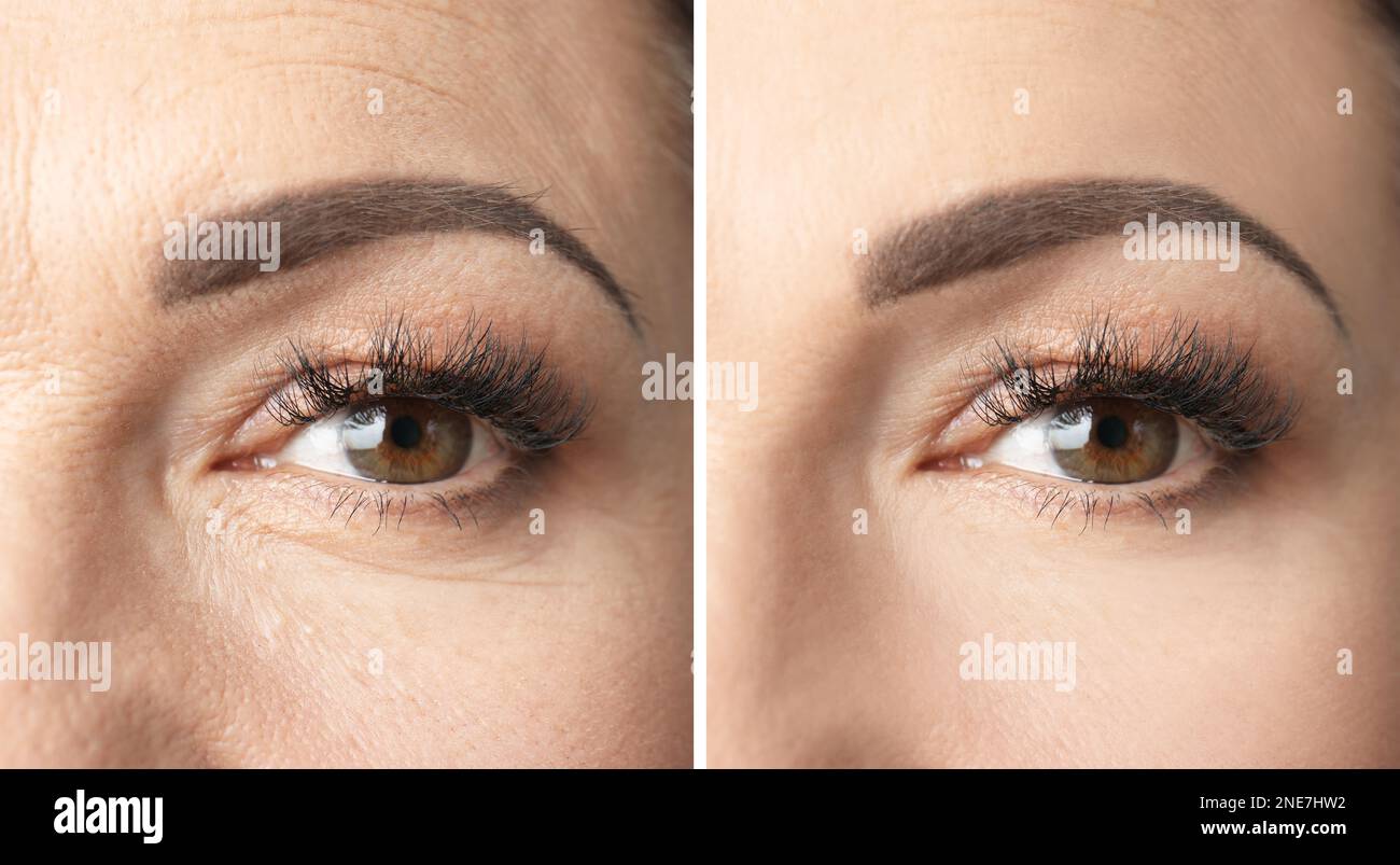 Collage with photos of mature woman before and after biorevitalization