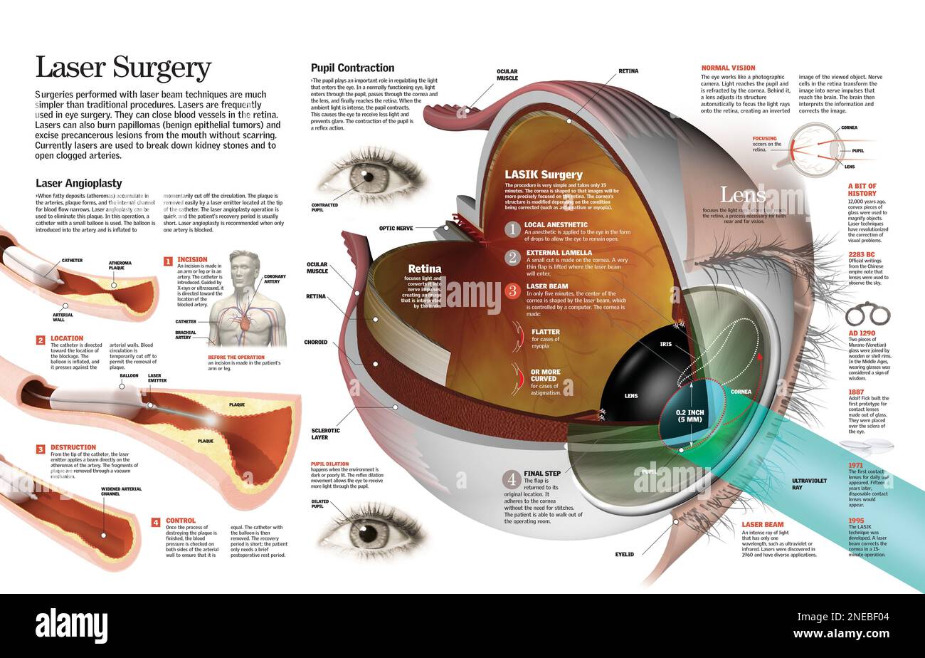 Infographic of an angioplasty and ocular surgery (or eye surgery) by