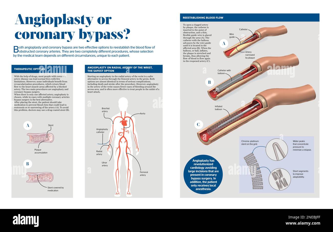 Infographic about angioplasty and gastric bypass, two alternatives to reestablish the blood flow