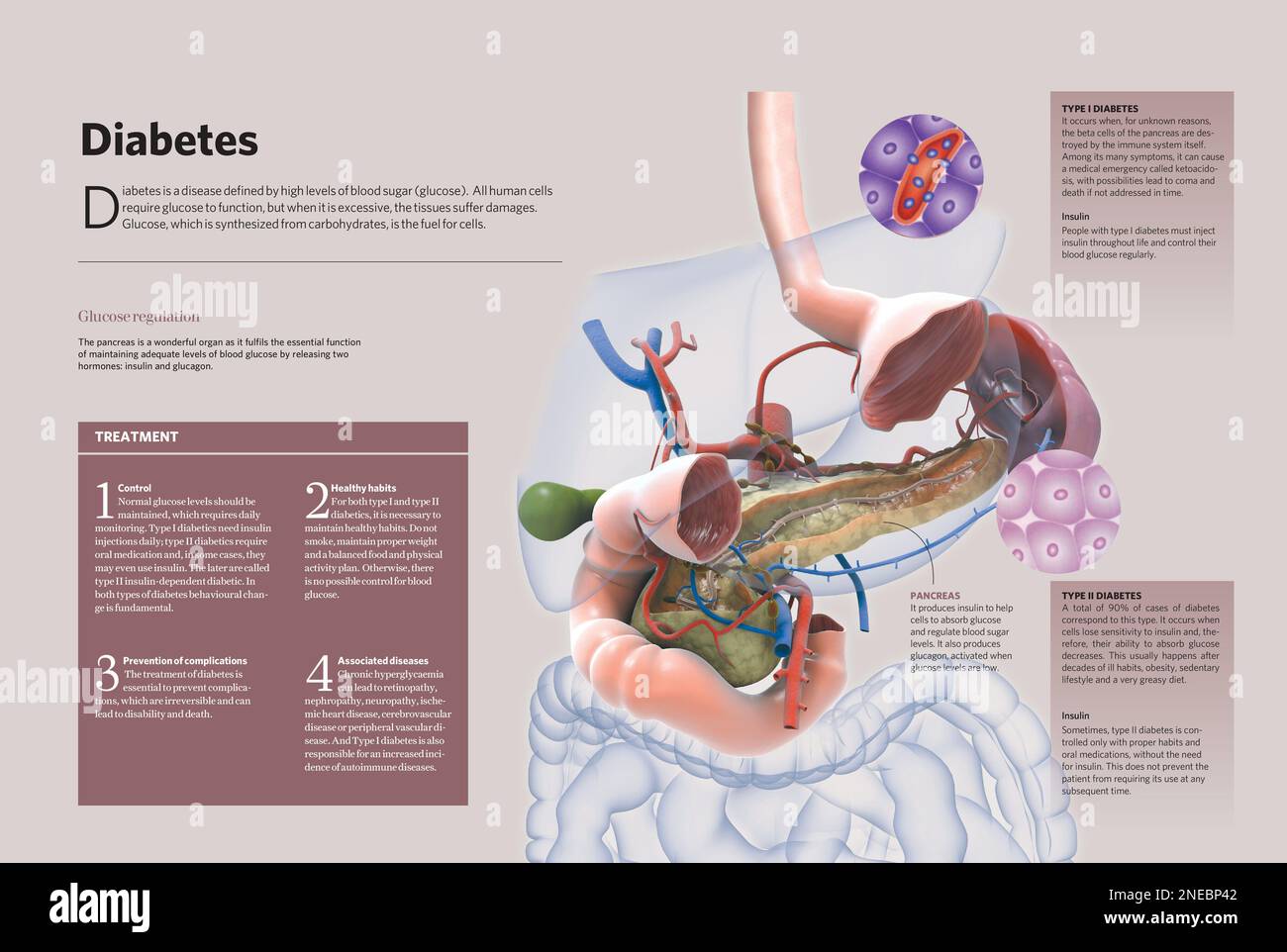 Infographic about diabetes, a disease that implies high levels of ...