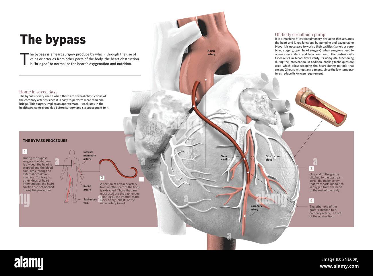 Infographic about bypass, a surgical technique used to restore the