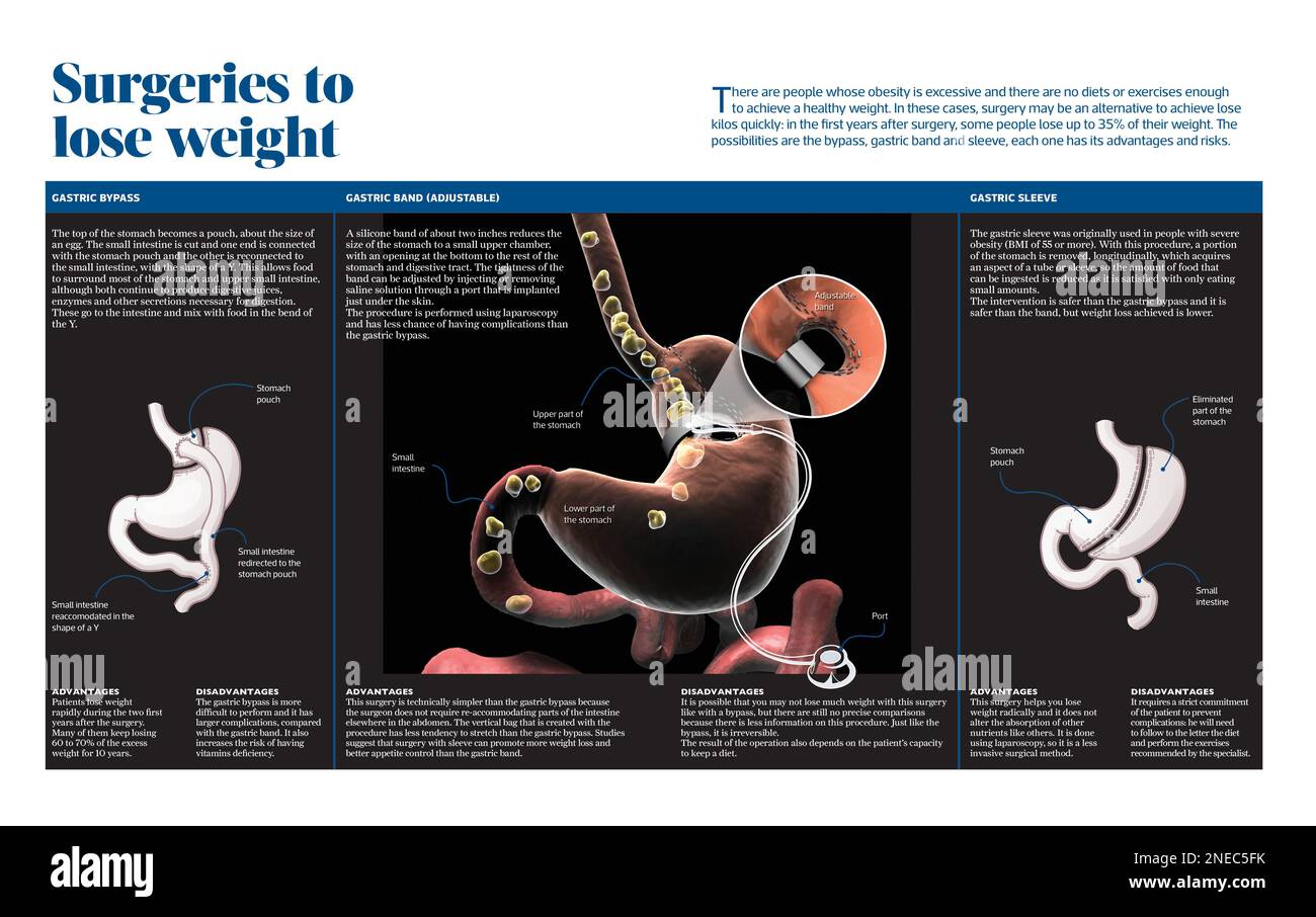 Infographic about the current surgical techniques for losing weight