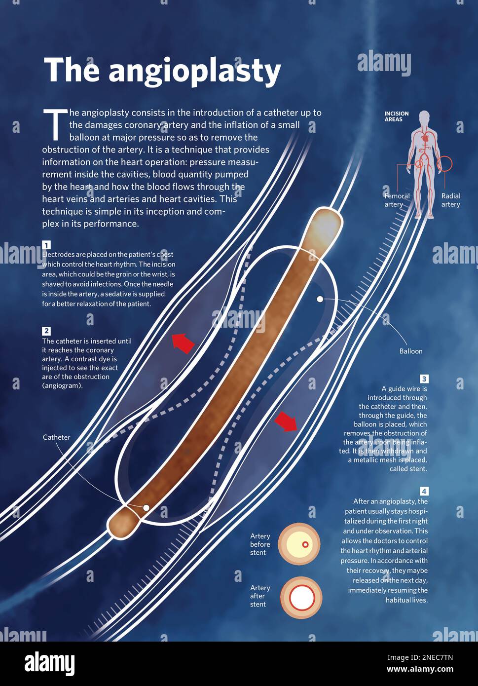 Infographic about angioplasty, the surgical removal of a blockage inside a blood vessel using a catheter. [Adobe InDesign (.indd)]. Stock Photo