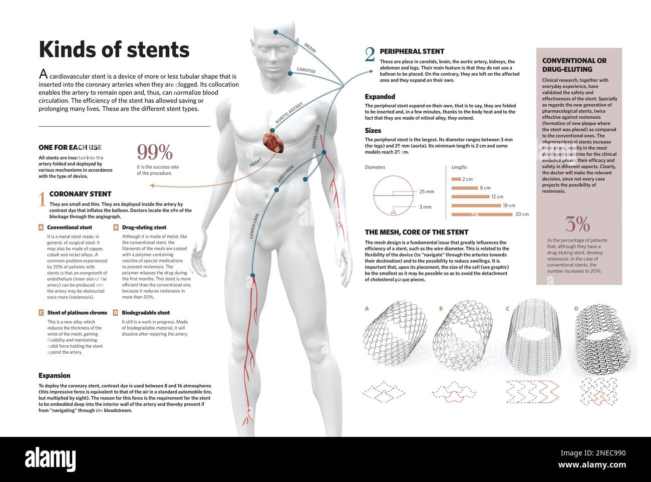 Infographic about heart stent (device introduced inside the arteries when they are blocked) and