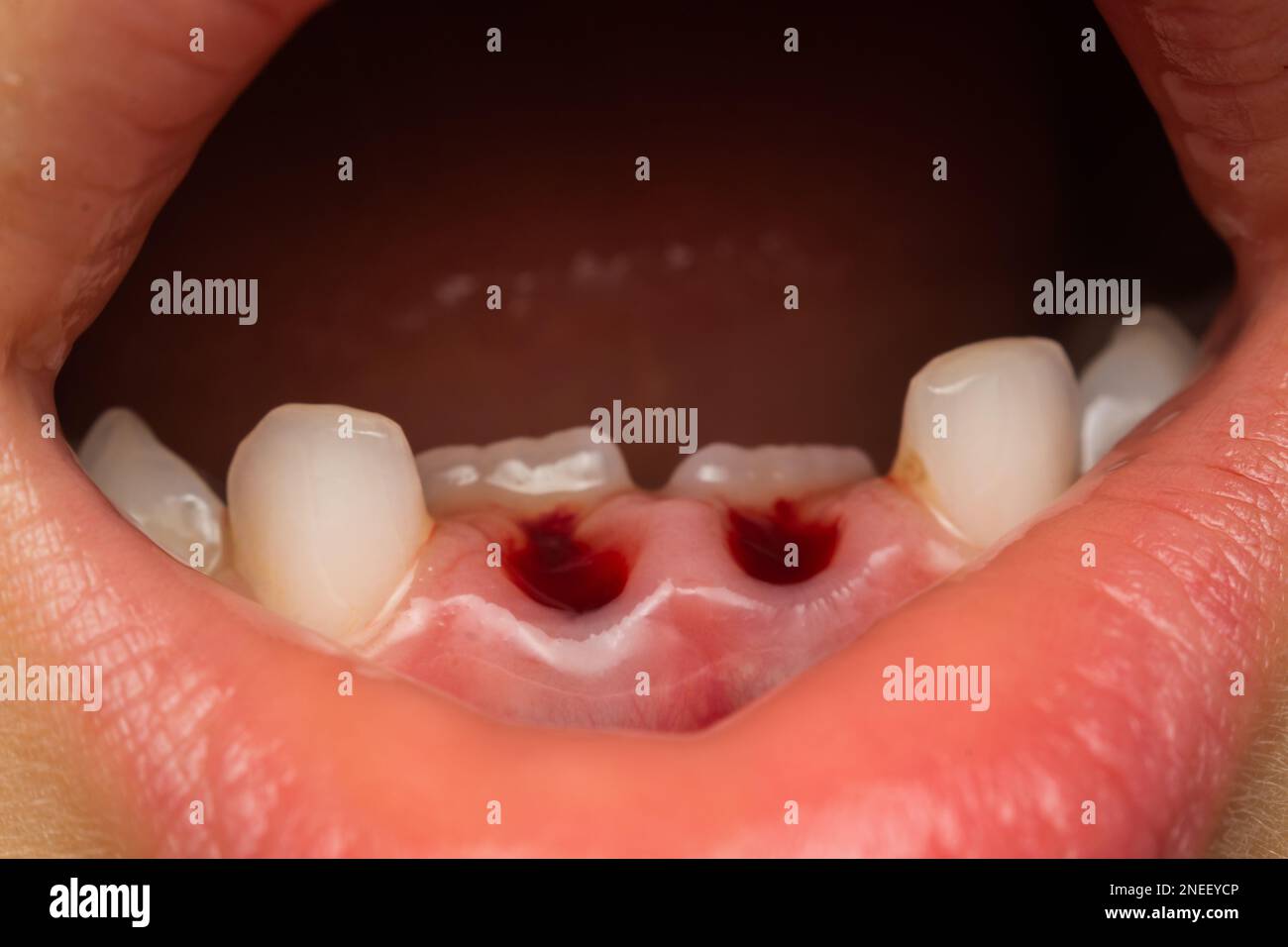 child mouth after deciduous teeth extraction Stock Photo Alamy