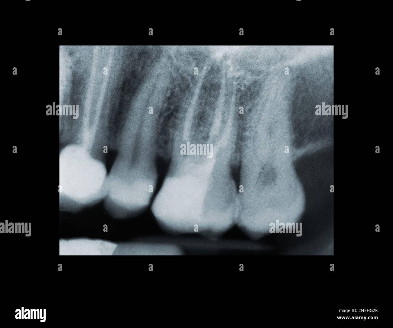 Real x-ray of devitalized tooth. X-ray of root canal treatment tooth