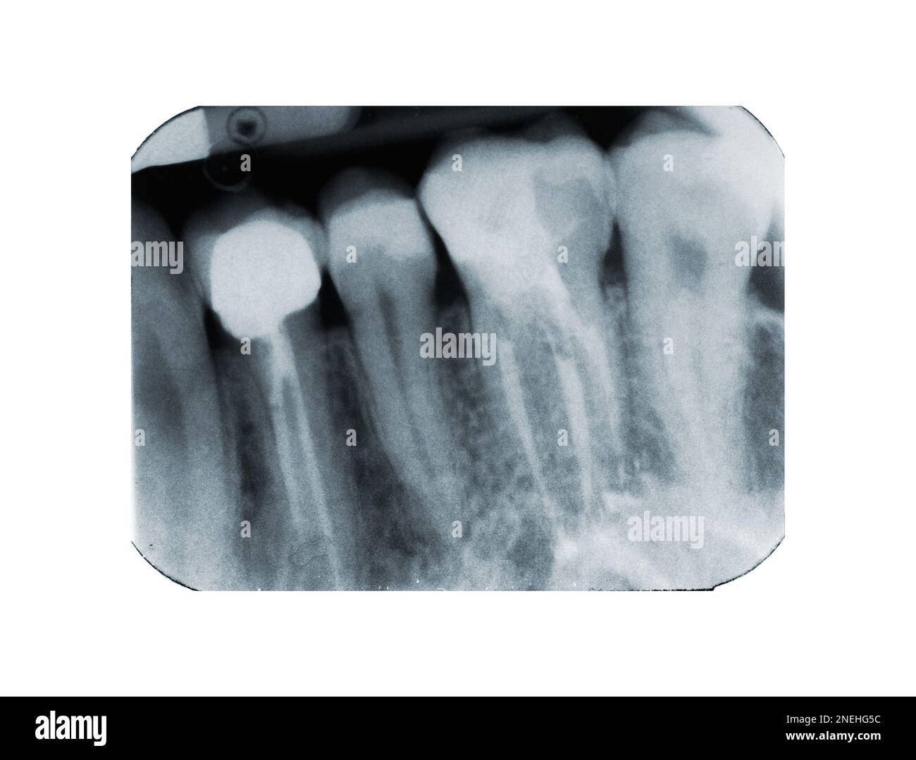 Real xray of devitalized tooth. Xray of root canal treatment tooth