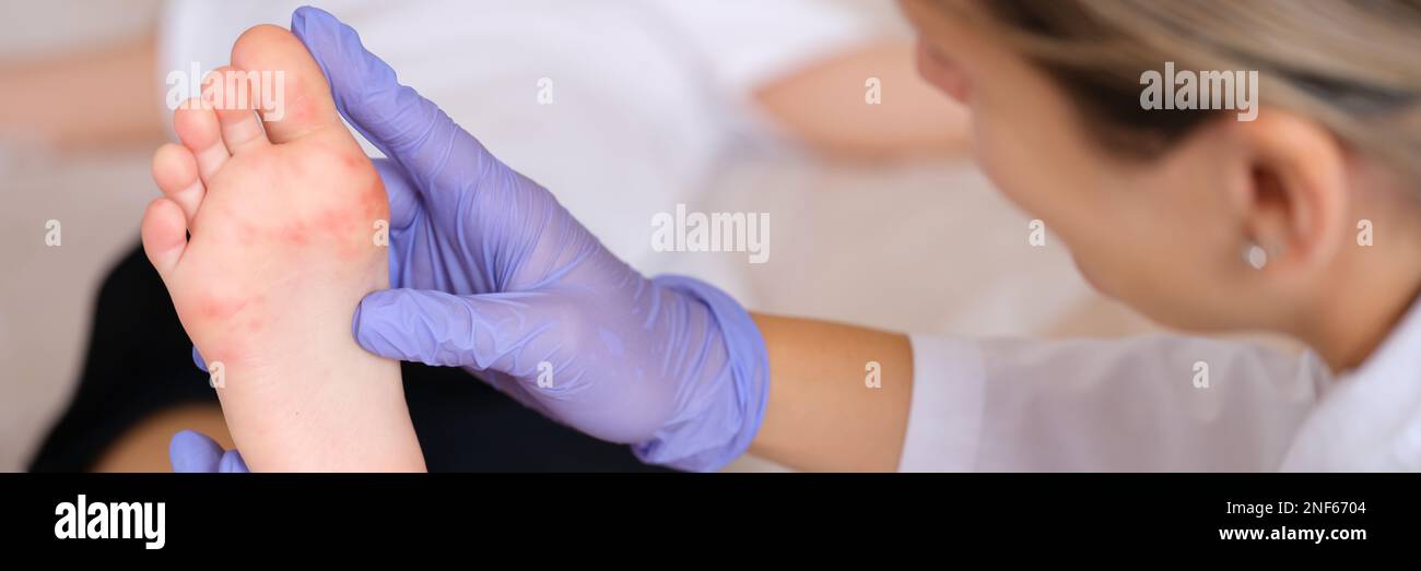 Doctor examining foot of child with red itchy rashes in clinic closeup Stock Photo