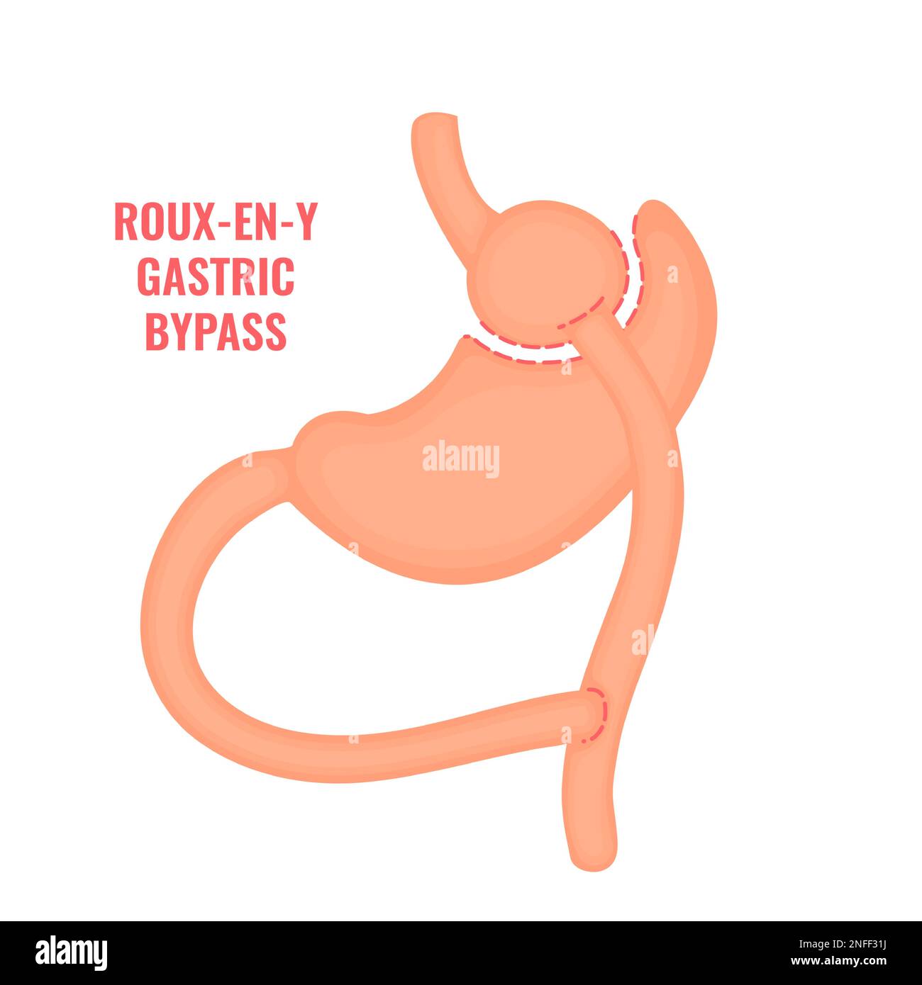 Roux-en-y gastric bypass bariatric surgery weight loss infographics Stock Vector